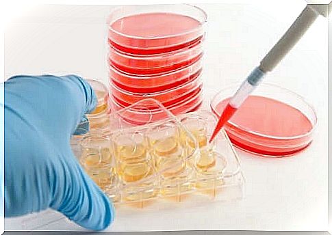 The diagnosis of actinomycosis is confirmed by microscopy and sputum culture, pus culture or biopsy