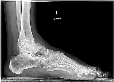 x-ray of the foot