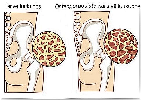 symptoms of osteoporosis