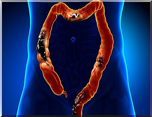 Avoid these foods if you have diverticulosis (a disease of the appendix)