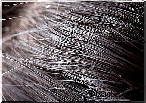 get rid of dandruff