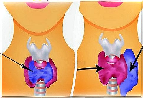 hyperthyroidism