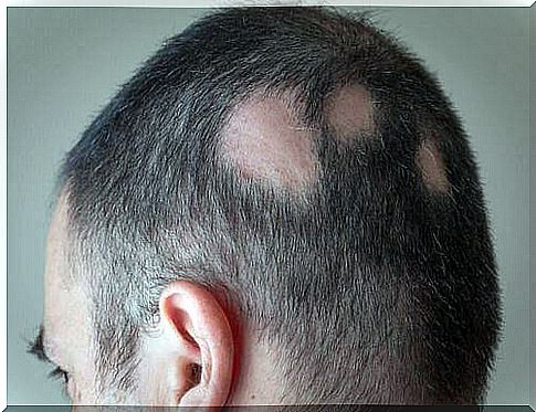 How to fight baldness by natural means