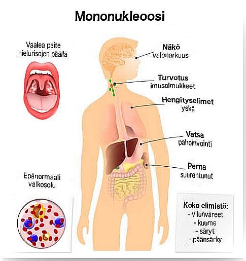 symptoms of mononucleosis