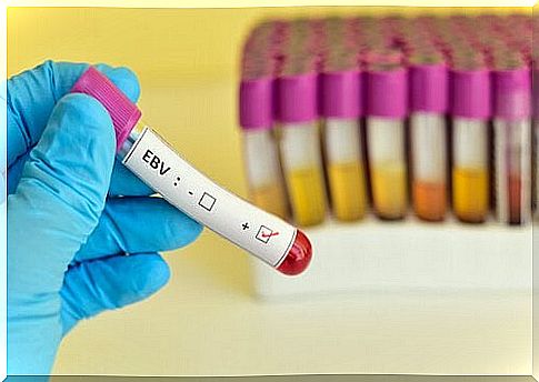 mononucleosis test