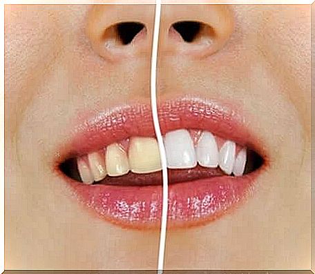 Teeth whitening naturally