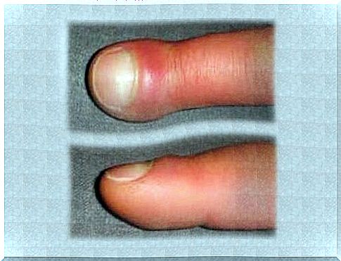 What causes swelling of the fingers?