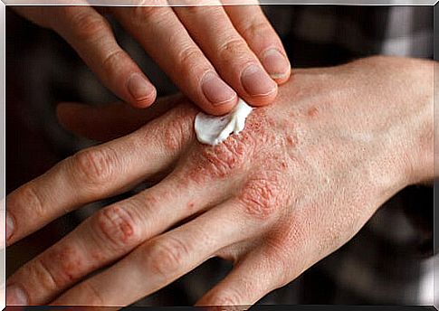 psoriasis in the hands